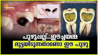 More About Tooth Worm | Malayalam Health News | Aanakkaryam |