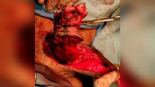 Total penectomy done for ca penis
