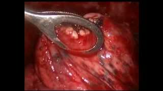 Туберкулез плевры, легкого - торакоскопия. Thoracoscopy tuberculosis lung and pleura