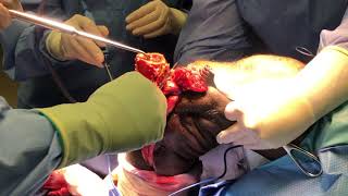 Below Knee Amputation