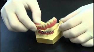 Prothese clipsee sur implant avec barre