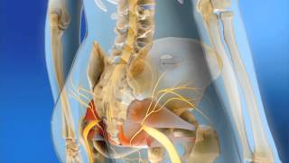 Medtronic Sacral Neuromodulation