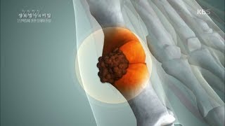 생로병사의 비밀 - 단백질 부족과 과잉! 몸의 이상을 일으킨다..20170913