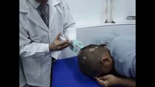 alopecia Areata Con Autohemoterapia