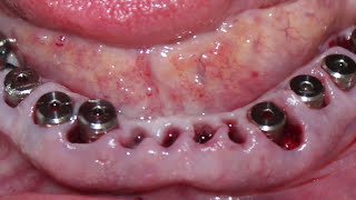 India Full Dental implant surgery procedure immediate extraction punjab jalandhar