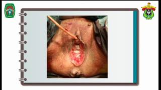 Vaginal Cystolithotomy (Sectio Alta) on a Pelvic Organ Prolapse and Multiple Vesicolithiasis patient