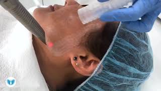 Before and After Micro Laser Peel, Skin Resurfacing Video