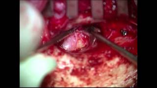 Tympanic membrane perforation. Miringoplastia Retroauricular con cartílago. Dr I. Domènech