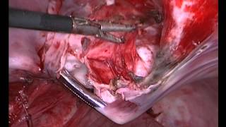Плеврэктомия при длительном пневмотораксе (буллы) -изменения плевры.. Pleurectomy