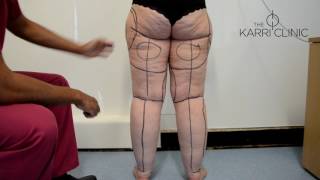 LIVE SURGERY: Liposuction for Type IV Stage II Lipoedema by Mr Vasu Karri | Before & After Images