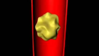 Cardio-Thrombose artere coronaire