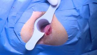 Laser hemorrhoidoplasty No1 Laser proctology seminar Vilnius, Clinic 2016