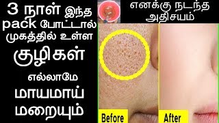 3 நாள் இந்த pack போட்டால் முகத்தில் உள்ள குழிகள் மாயமாய் மறைய | Open Large Pores on Face in tamil