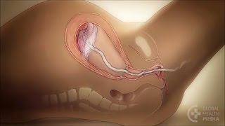 Managing the Third Stage of Labor - Childbirth Series