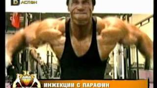 Пластична хирургия - Удебеляване на пенис с парафин