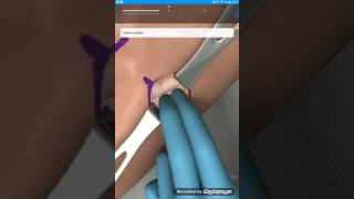ORTOPEDIA, Septica de cadera pediatrica. FASE 3/4: Drenaje anterior de la cadera. Parte 2 de 3
