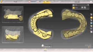 inLab SW 15 – Multi-Unit Implant Bridge