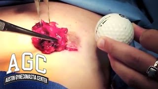What is "Golf Ball" Gynecomastia? - Puffy Nipples - Austin Gynecomastia Center