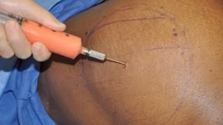 Butt Injection Info Kit 3 - Hydrogel Silicon Nightmare