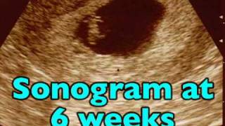 First Trimester Sonograms (Pregnancy Health Guru)