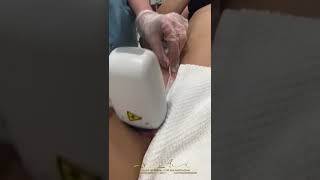 Лазерная эпиляция зоны бикини