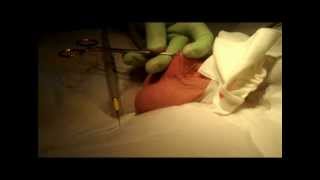 VASECTOMY SUMMARY VIDEO  --  NO NEEDLE NO SCALPEL TECHNIQUE    MONTREAL DR  ZORN