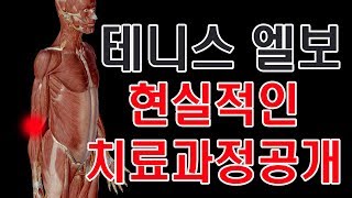 테니스엘보 팔꿈치통증환자 치료전과정을 생생하게 보세요.