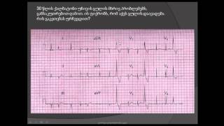პარკუჭოვანი ექსტრასისტოლა (parkuchovani eqstrasistola, eqstrasistolia). eleqtrokardiogramis garcheva