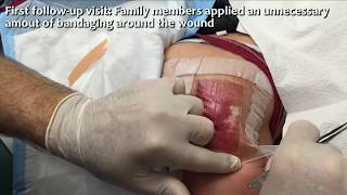 10-Year-Old Cyst - Dr. Gilmore Treatment