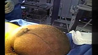 HOW TO AVOID SEROMA IN THE REPAIR OF LARGE INGUINOSCROTAL HERNIA  THE MOVIE