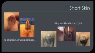 Complications After Hypospadias Repair