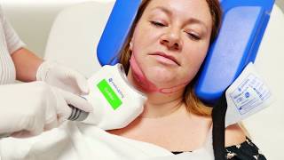 Coolsculpting - die nicht-invasive Fettreduzierung
