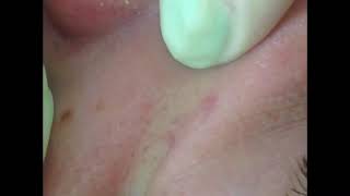 Mechanical cleaning of the face, removal of acne, facial peels, чистка лица , удаление угрей , прыщи