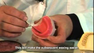 Deflex flexible dentures Video 10 Flask placement – Injection tubes