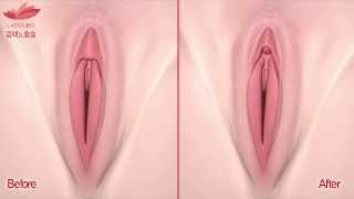 레이디유로 음핵노출술(음핵수술)(클리토리스 노출술) 3차원 시뮬레이션 HD영상