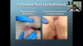 Современное лечение кисты копчика, вебинар 24.04.2015