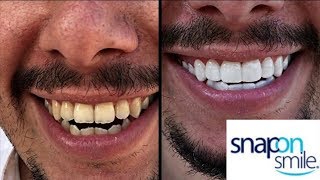 Snap On Smile Инструкция
