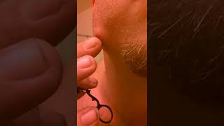 Tooth infection so bad I had to pop it myself!!!