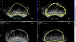 Analisis ecografia volumetrica de prostata