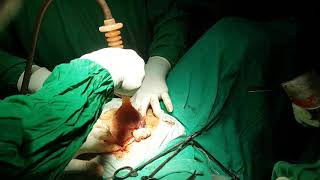 Technique using vacuum cup to remove large uterus during Total abdominal hysterectomy