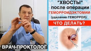 Хвосты после операции геморроидэктомии (удаление геморроя). Лечение геморроя