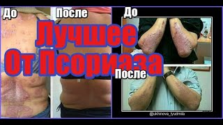 Лучшее Средство От Псориаза Отзывы-Смотрите!