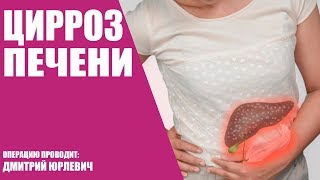 Цирроз печени/Операция
