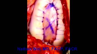 Breakthrough cartilage repair treatment options including stem cells for arthritis!
