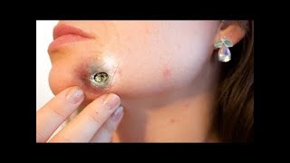 Новое выдавливание ПРЫЩЕЙ и ЧЕРНЫХ ТОЧЕК!  p25