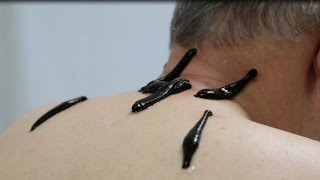 Гирудотерапия - лечение пиявками