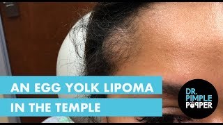 An Egg Yolk Lipoma in the Temple