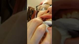 !!TOOTH ABSCESS POPPING!! WATCH AT YOUR OWN RISK!!!