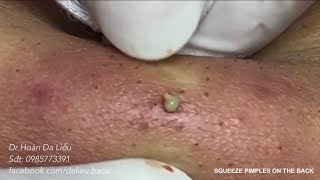 Nặn mụn nhọt, mụn bọc ở lưng đầy mủ siêu nhiều| Squeeze super big big pimples on the back dr Hoan