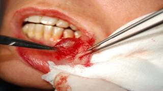Mucocele labial. A propósito de un caso.